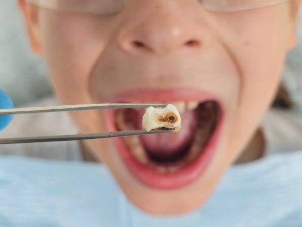 Best Emergency Broken Tooth Repair in Lyman, MS
