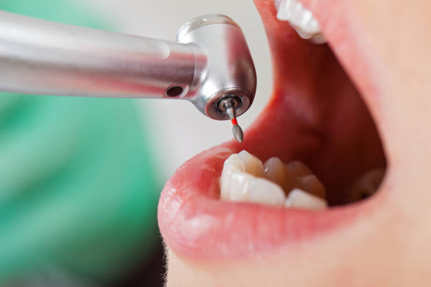 Best Emergency Tooth Extraction in Lyman, MS